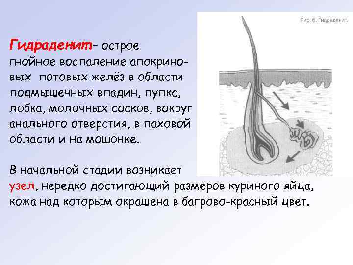 Гидраденит – острое гнойное воспаление апокриновых потовых желёз в области подмышечных впадин, пупка, лобка,