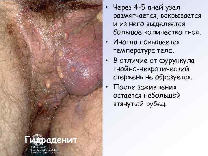  • Через 4 -5 дней узел размягчается, вскрывается и из него выделяется большое