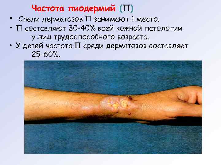 Частота пиодермий (П) • Среди дерматозов П занимают 1 место. • П составляют 30