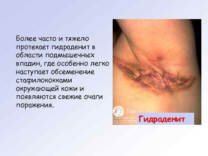 Более часто и тяжело протекает гидраденит в области подмышечных впадин, где особенно легко наступает