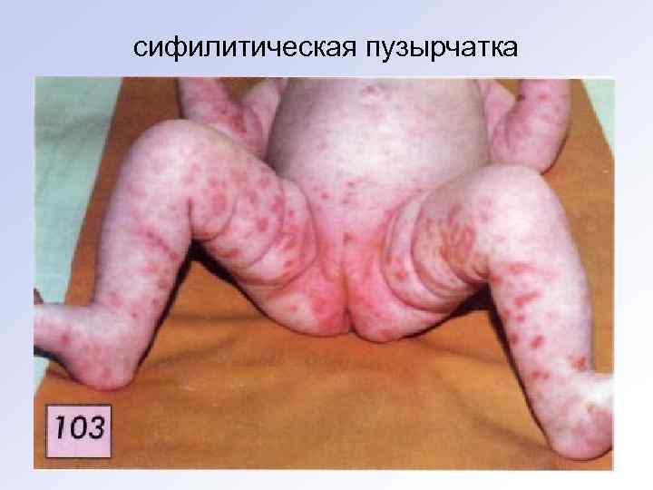 сифилитическая пузырчатка 