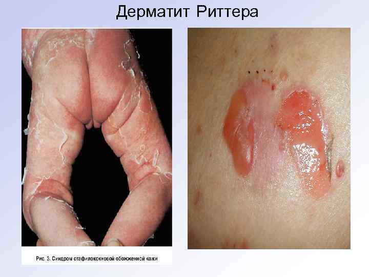 Дерматит Риттера 