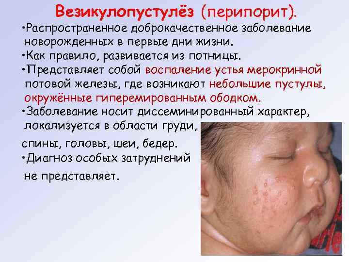 Везикулопустулёз (перипорит). • Распространенное доброкачественное заболевание новорожденных в первые дни жизни. • Как правило,