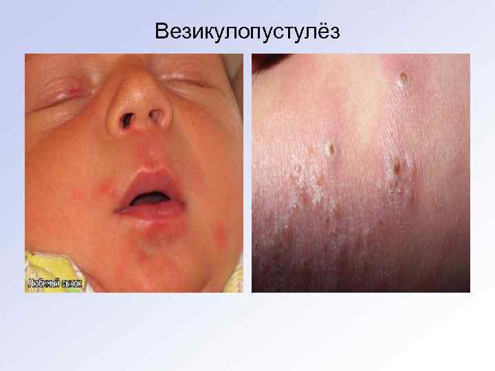 Везикулопустулёз 
