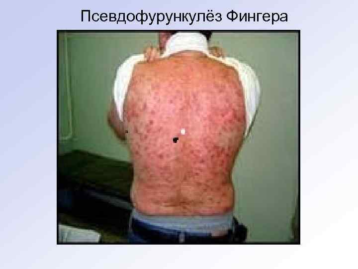 Псевдофурункулёз Фингера 