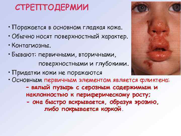 СТРЕПТОДЕРМИИ • Поражается в основном гладкая кожа. • Обычно носят поверхностный характер. • Контагиозны.