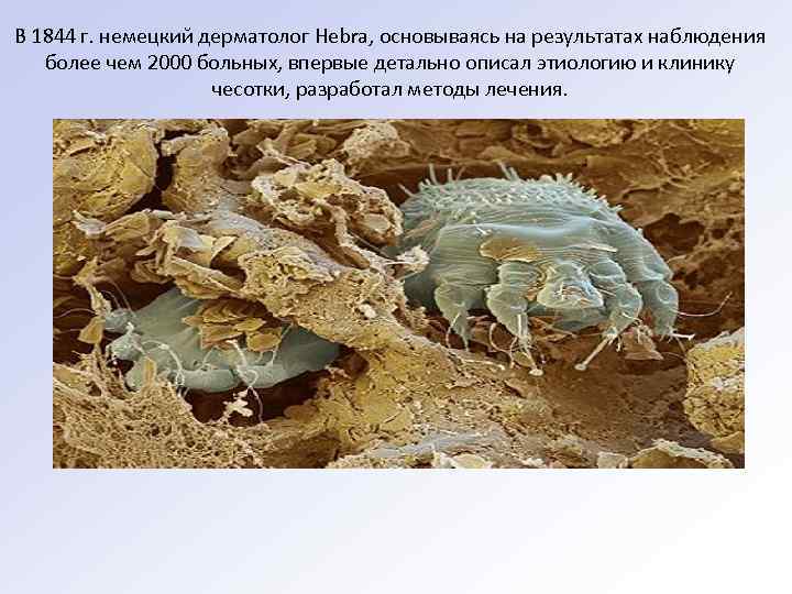 В 1844 г. немецкий дерматолог Hebra, основываясь на результатах наблюдения более чем 2000 больных,