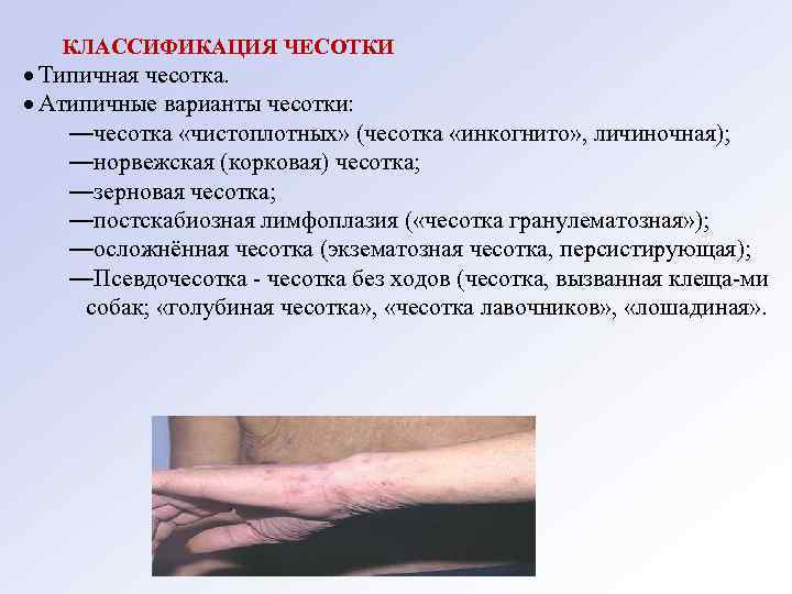 КЛАССИФИКАЦИЯ ЧЕСОТКИ Типичная чесотка. Атипичные варианты чесотки: —чесотка «чистоплотных» (чесотка «инкогнито» , личиночная); —норвежская