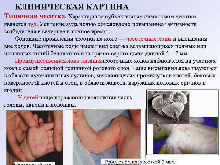 КЛИНИЧЕСКАЯ КАРТИНА Типичная чесотка. Характерным субъективным симптомом чесотки является зуд. Усиление зуда ночью обусловлено