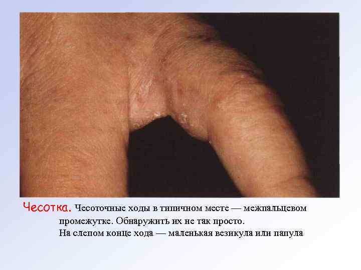 Чесотка. Чесоточные ходы в типичном месте — межпальцевом промежутке. Обнаружить их не так просто.