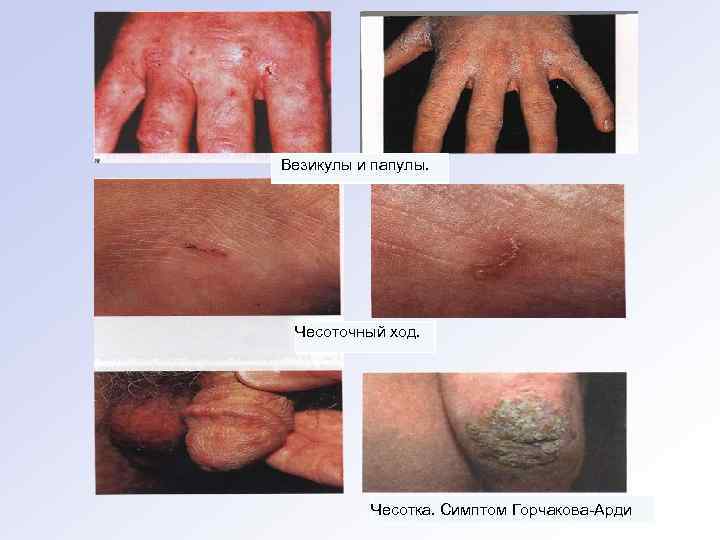 Везикулы и папулы. Чесоточный ход. Чесотка. Симптом Горчакова-Арди 