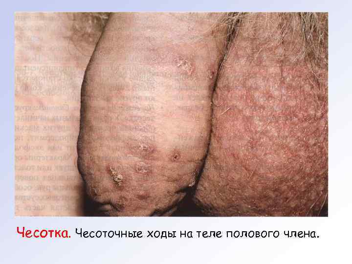 Чесотка. Чесоточные ходы на теле полового члена. 