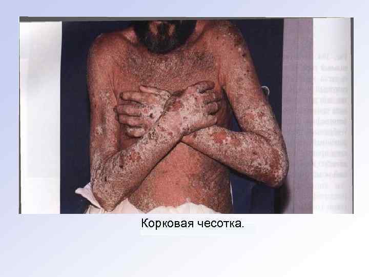 Корковая чесотка. 