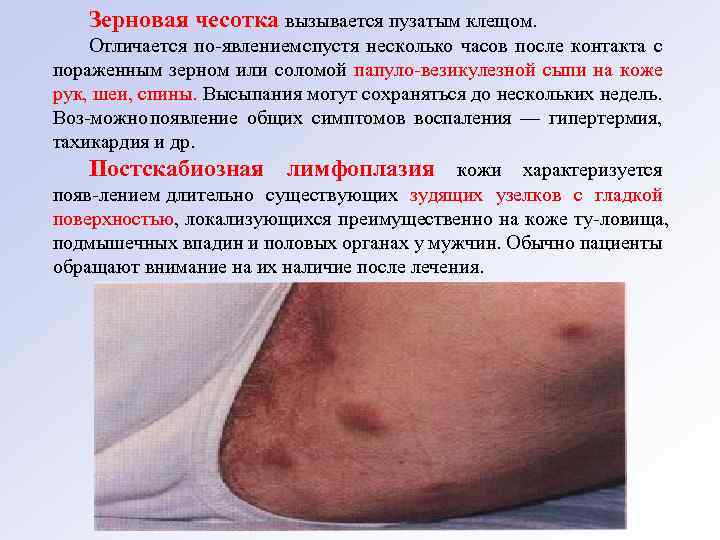 Зерновая чесотка вызывается пузатым клещом. Отличается по явлением спустя несколько часов после контакта с