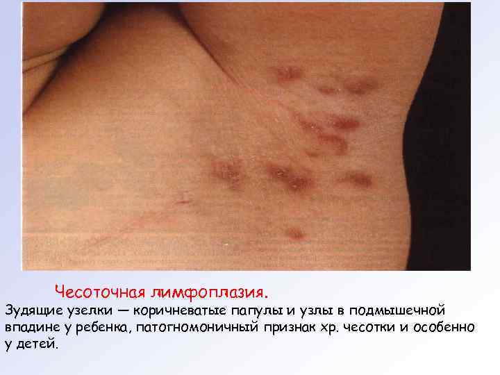 Чесоточная лимфоплазия. Зудящие узелки — коричневатые папулы и узлы в подмышечной впадине у ребенка,