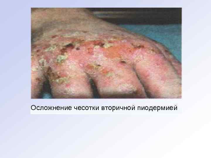 Осложнение чесотки вторичной пиодермией 