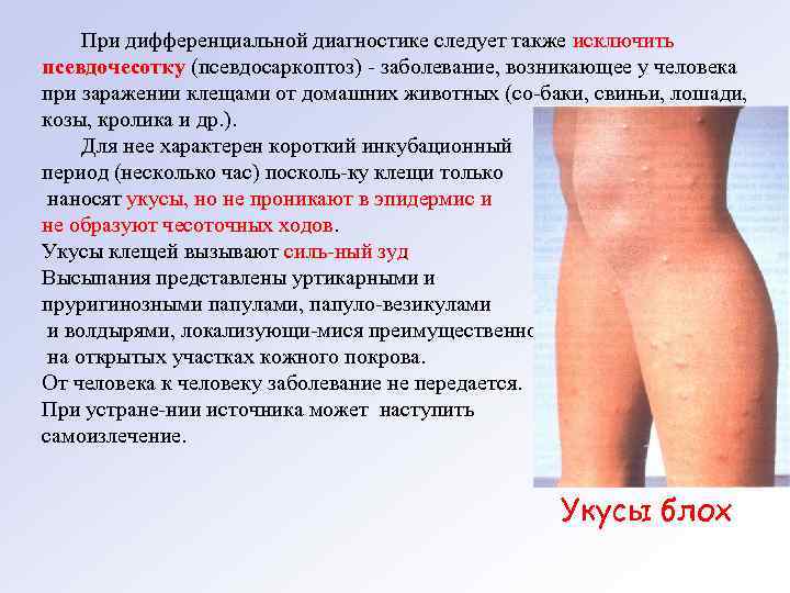 При дифференциальной диагностике следует также исключить псевдочесотку (псевдосаркоптоз) заболевание, возникающее у человека при заражении