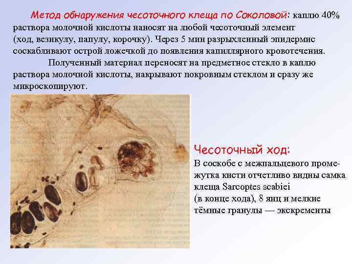 Метод обнаружения чесоточного клеща по Соколовой: каплю 40% раствора молочной кислоты наносят на любой