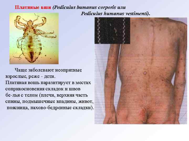 Платяные вши (Pediculus bumanus corporis или Pediculus humanus vestimenti). Чаще заболевают неопрятные взрослые, реже
