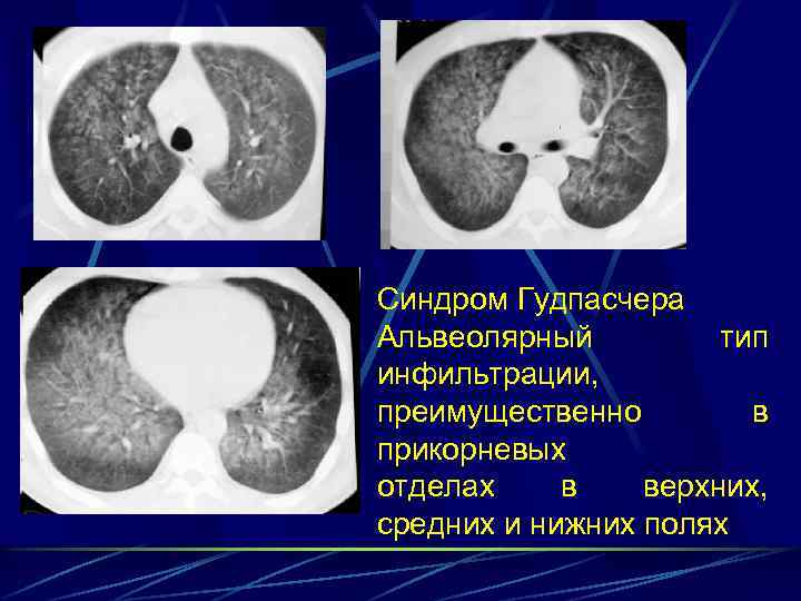 Синдром Гудпасчера Альвеолярный тип инфильтрации, преимущественно в прикорневых отделах в верхних, средних и нижних
