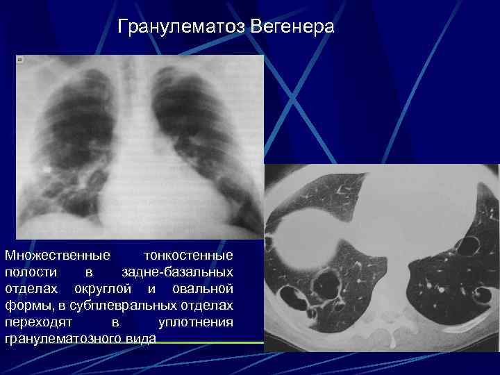 Гранулематоз Вегенера Множественные тонкостенные полости в задне-базальных отделах округлой и овальной формы, в субплевральных