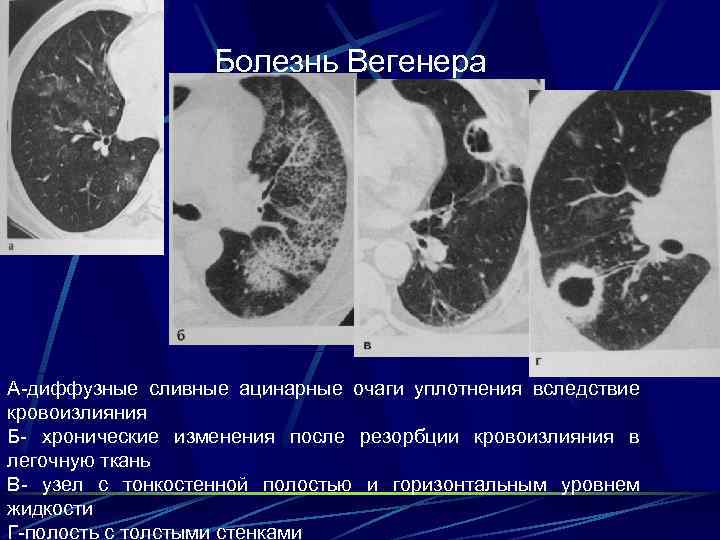 Синдром вегенера картинки