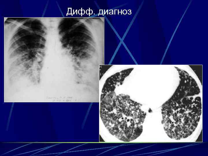 Дифф. диагноз 