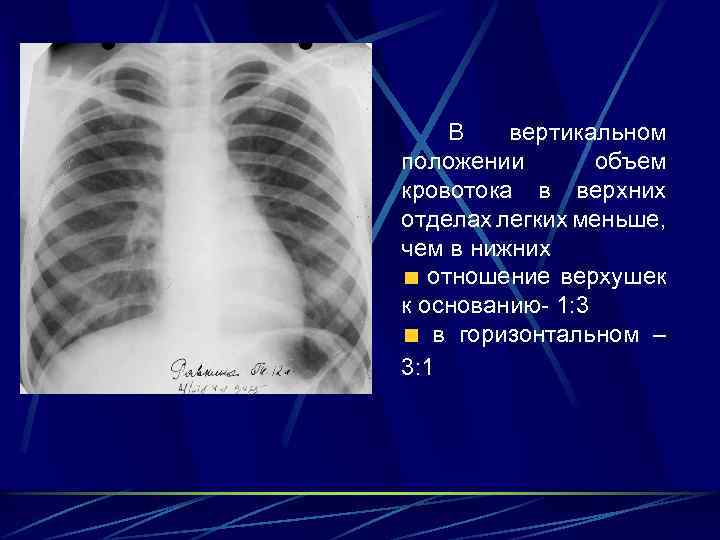  В вертикальном положении объем кровотока в верхних отделах легких меньше, чем в нижних