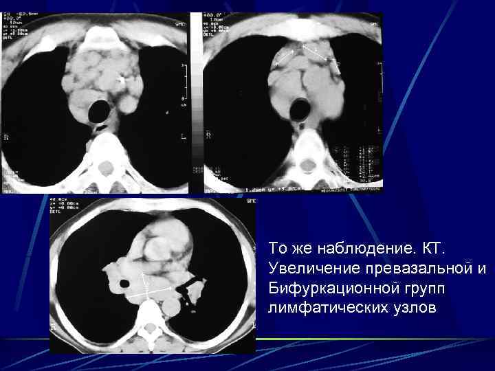 То же наблюдение. КТ. Увеличение превазальной и Бифуркационной групп лимфатических узлов 