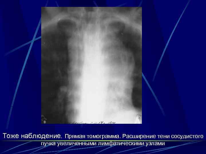 Тоже наблюдение. Прямая томограмма. Расширение тени сосудистого пучка увеличенными лимфатическими узлами 