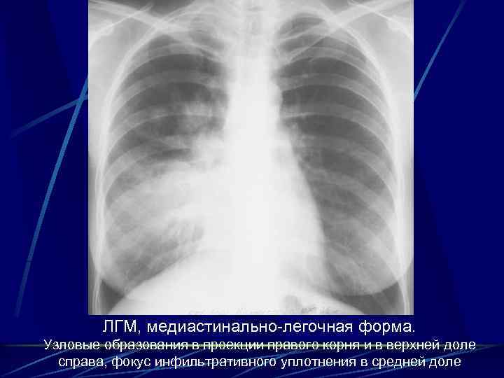 ЛГМ, медиастинально-легочная форма. Узловые образования в проекции правого корня и в верхней доле справа,