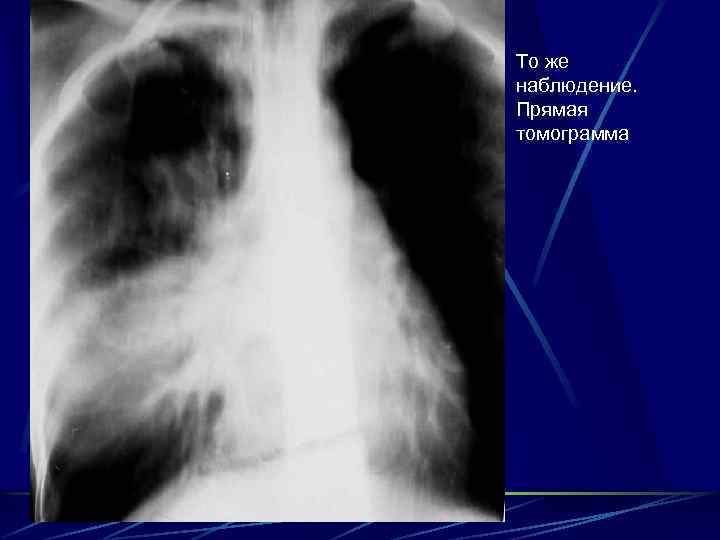 То же наблюдение. Прямая томограмма 