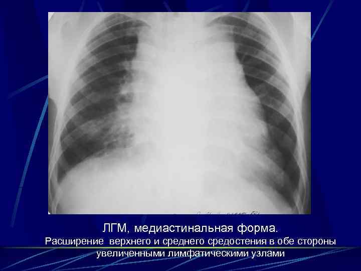 ЛГМ, медиастинальная форма. Расширение верхнего и среднего средостения в обе стороны увеличенными лимфатическими узлами