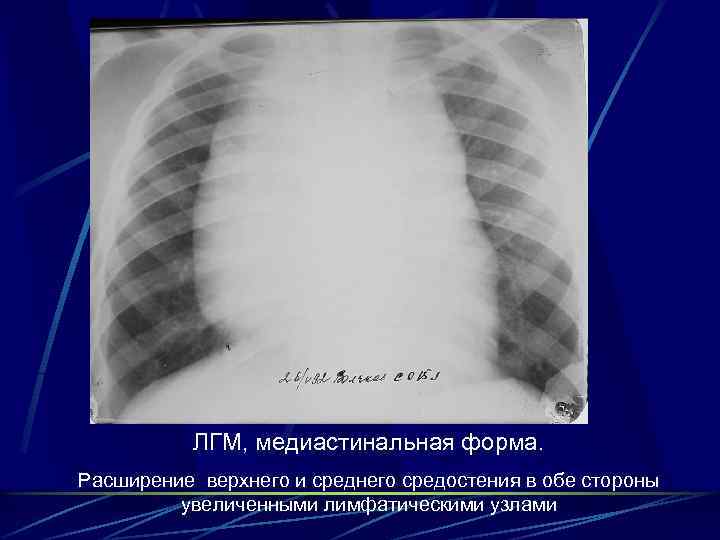 ЛГМ, медиастинальная форма. Расширение верхнего и среднего средостения в обе стороны увеличенными лимфатическими узлами