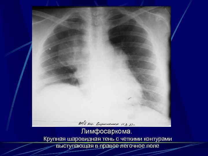 Лимфосаркома. Крупная шаровидная тень с четкими контурами выступающая в правое легочное поле 