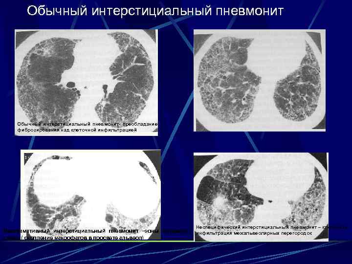 Обычный интерстициальный пневмонит- преобладание фиброзирования над клеточной инфильтрацией Десквамативный интерстициальный пневмонит –зоны матового стекла(