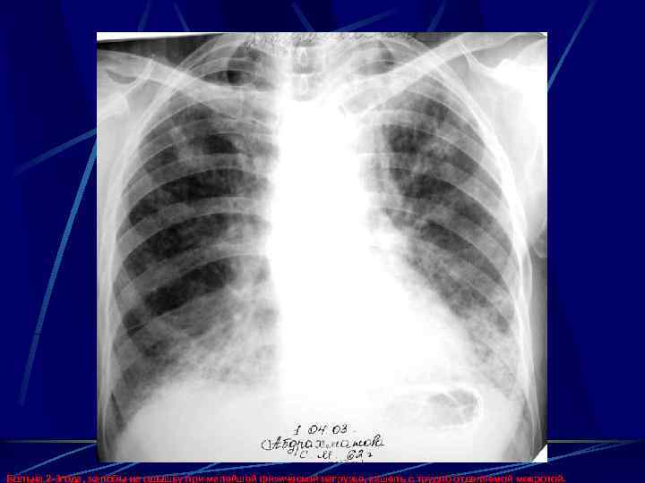 Больна 2 -3 года, жалобы на одышку при малейшей физической нагрузке, кашель с трудно
