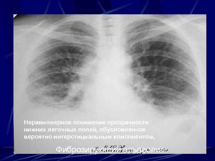 Неравномерное понижение прозрачности нижних легочных полей, обусловленное вероятно интерстициальным комопнентом, Фиброзирующий альвеолит 