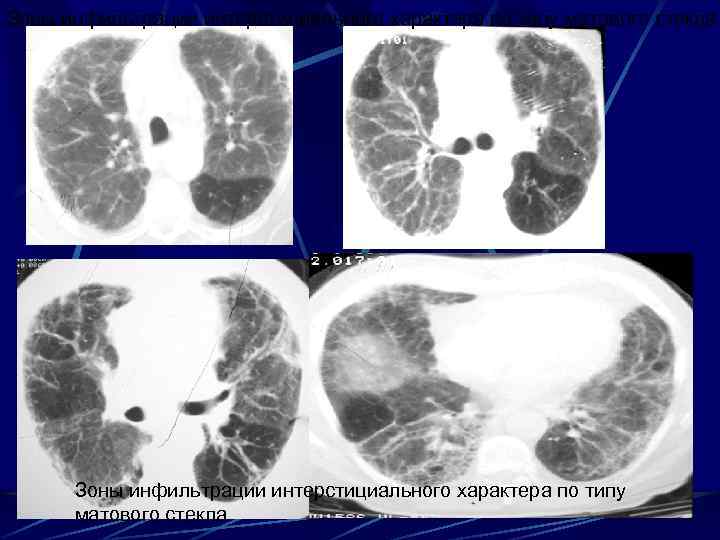 Зоны инфильтрации интерстициального характера по типу матового стекла 
