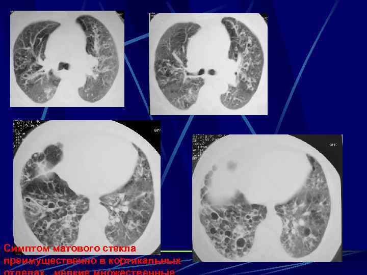 Симптом матового стекла преимущественно в кортикальных 