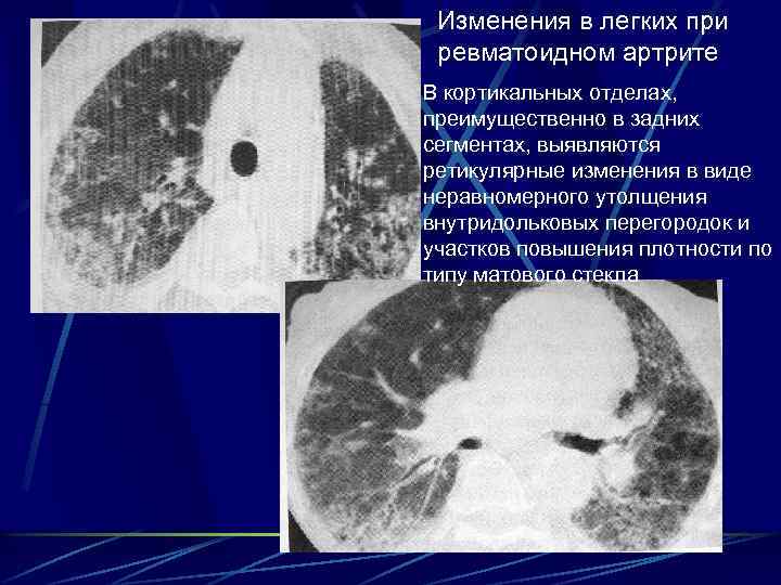 Изменения в легких при ревматоидном артрите В кортикальных отделах, преимущественно в задних сегментах, выявляются