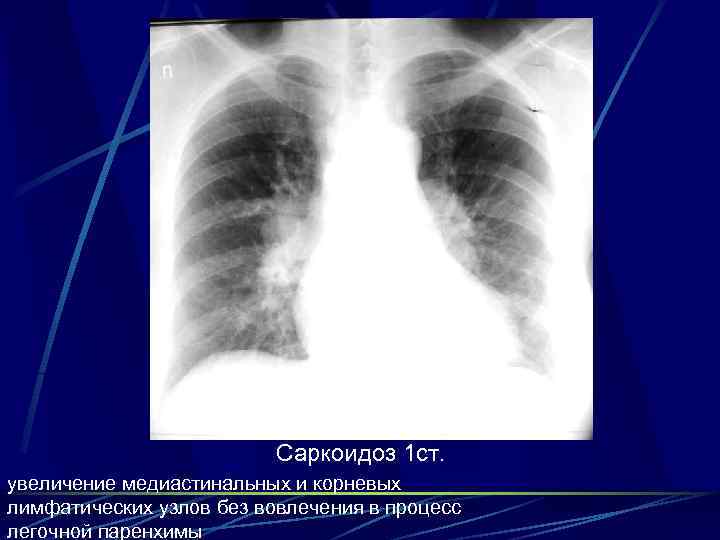 Саркоидоз 1 ст. увеличение медиастинальных и корневых лимфатических узлов без вовлечения в процесс легочной