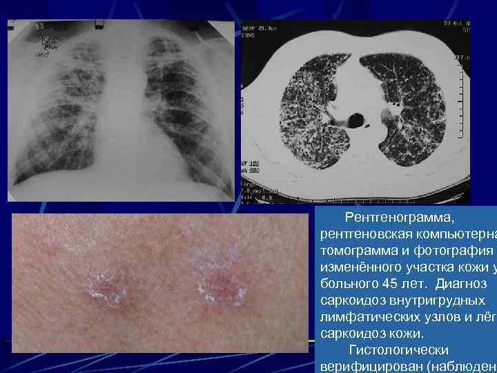 Рентгенограмма, рентгеновская компьютерна томограмма и фотография изменённого участка кожи у больного 45 лет. Диагноз