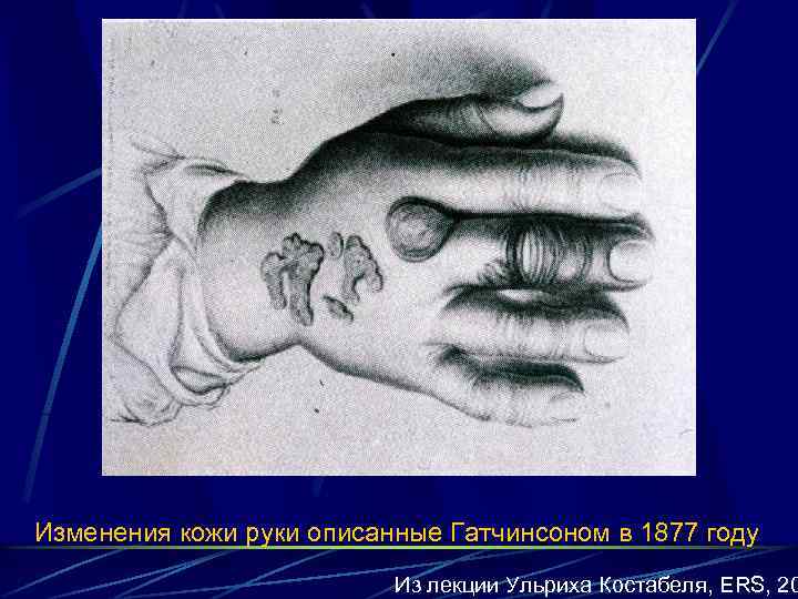 Изменения кожи руки описанные Гатчинсоном в 1877 году Из лекции Ульриха Костабеля, ERS, 20