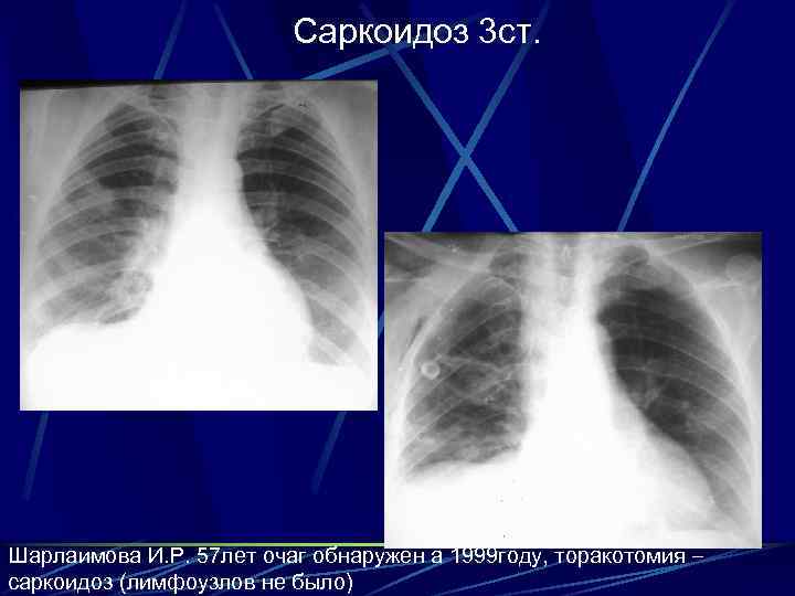 Саркоидоз 3 ст. Шарлаимова И. Р. 57 лет очаг обнаружен а 1999 году, торакотомия
