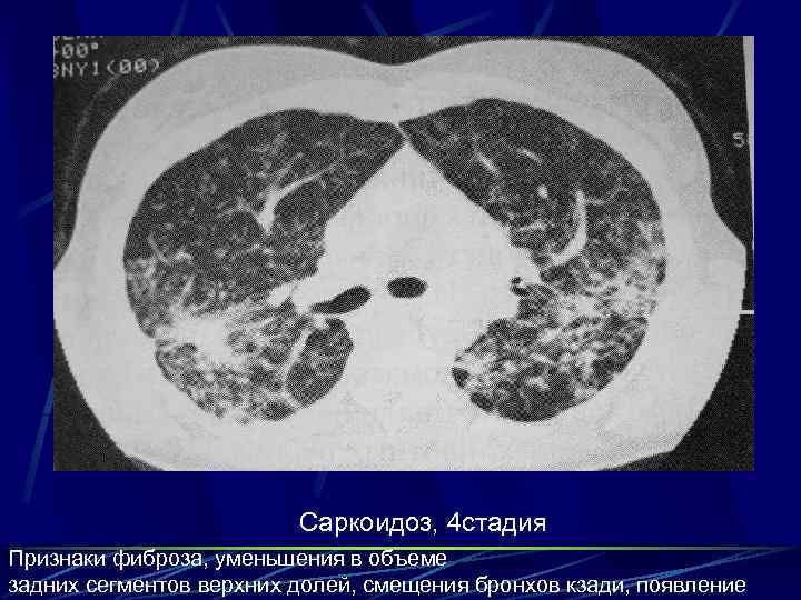 Саркоидоз, 4 стадия Признаки фиброза, уменьшения в объеме задних сегментов верхних долей, смещения бронхов