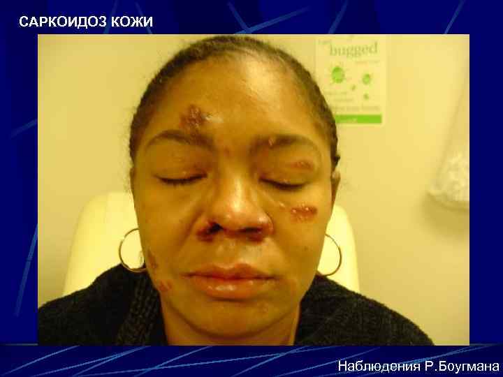 САРКОИДОЗ КОЖИ Наблюдения Р. Боугмана 