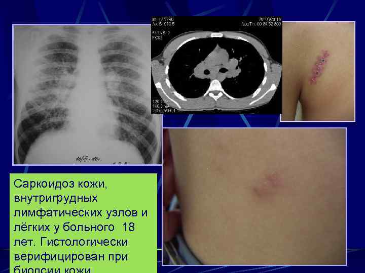 Саркоидоз кожи, внутригрудных лимфатических узлов и лёгких у больного 18 лет. Гистологически верифицирован при