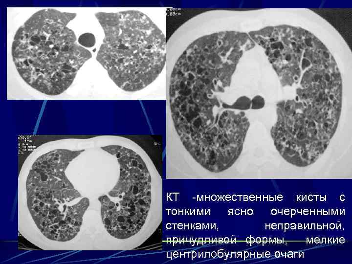 КТ -множественные кисты с тонкими ясно очерченными стенками, неправильной, причудливой формы, мелкие центрилобулярные очаги