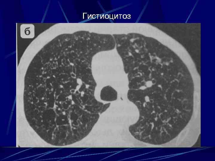 Гистиоцитоз 